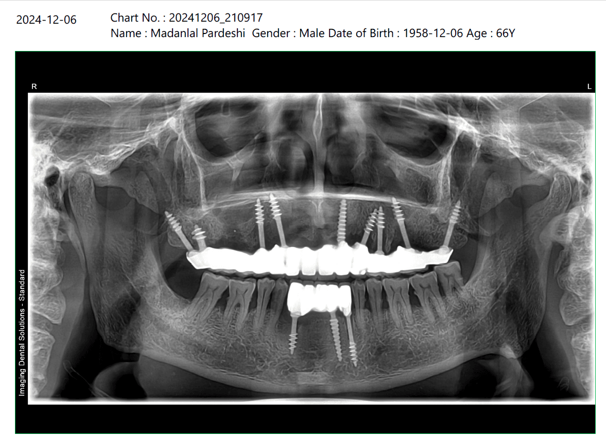 Madanlal Pardesi X-ray after treatment