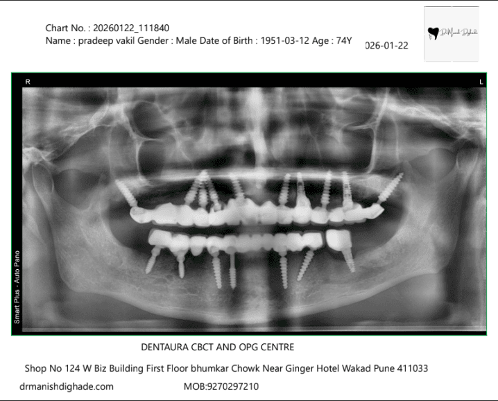 Pradeep Vakil X-ray after treatment