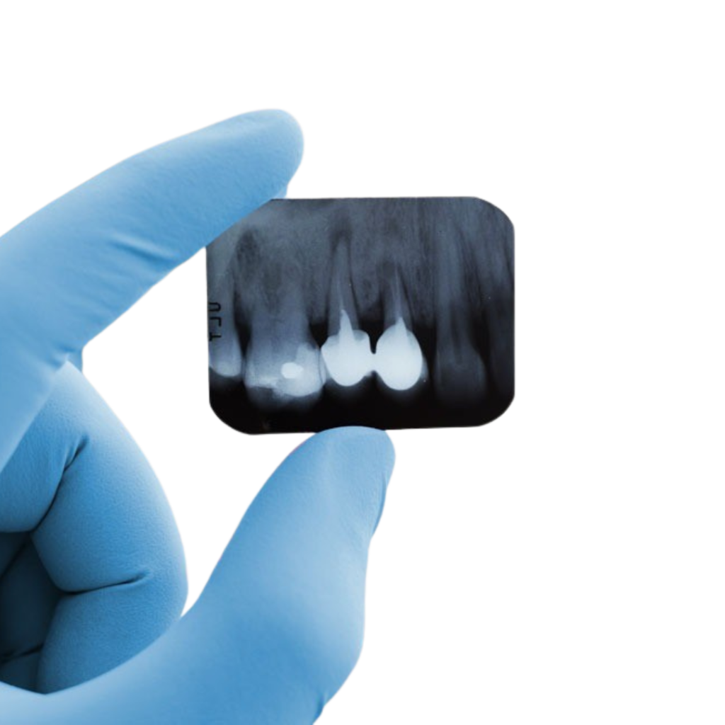 Ultimate Guide to Root Canal Treatment: Transform Your Smile with No. 1 Dentist in Wakad Pune | Affordable and Best Dental Treatment in PCMC Dental xray