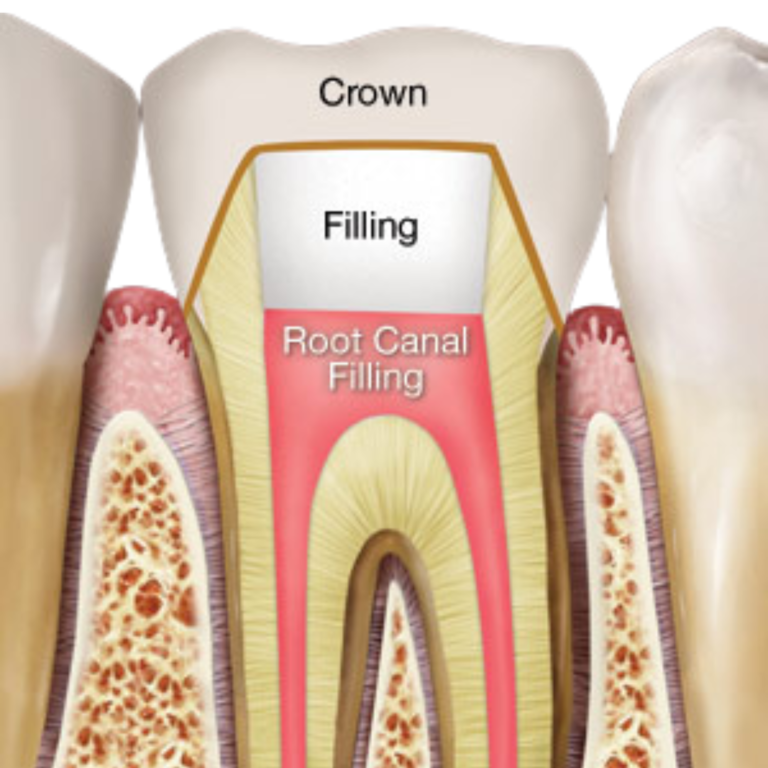 crowning of tooth