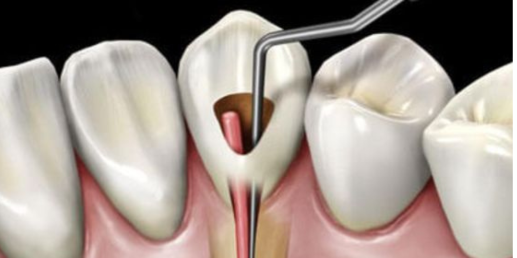 Root Canal Treatment