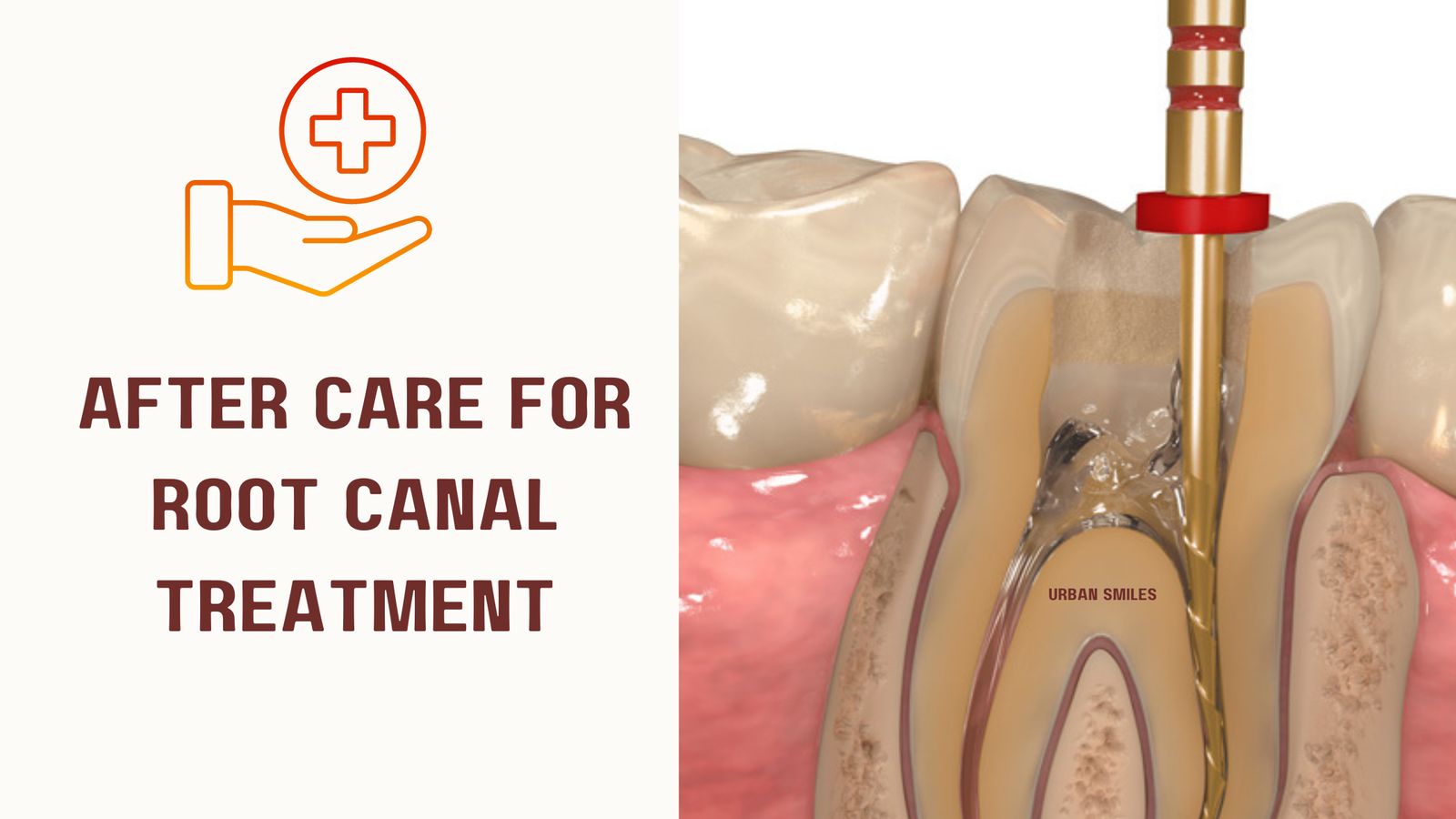Aftercare for Root Canal Treatment