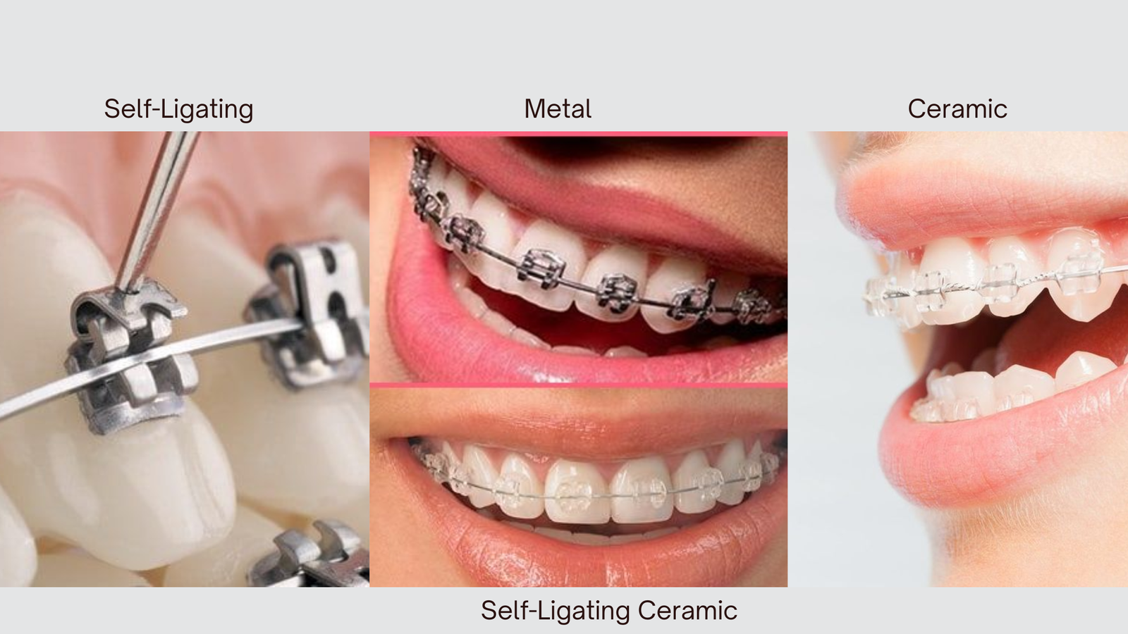 Orthodontic braces