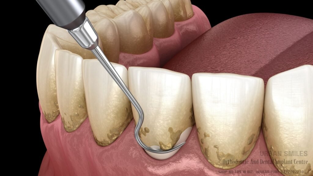 No 1 Ultimate Guide to Teeth Cleaning: Transform Your Smile | Affordable and Best Dental Treatment in PCMC teeth cleaning